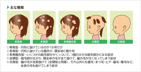 円形脱毛症 髪の悩み ネイチャー生活倶楽部 ホームページ 公式